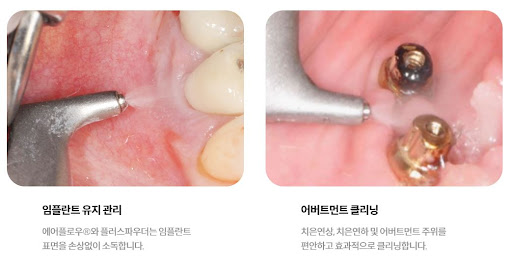 천안 임플란트와 치아교정을 위한 최고의 선택, 불당본점 서울비디치과의원