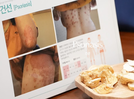 생기한의원 건선 각질, 일반 건조함과 다른 점 정리